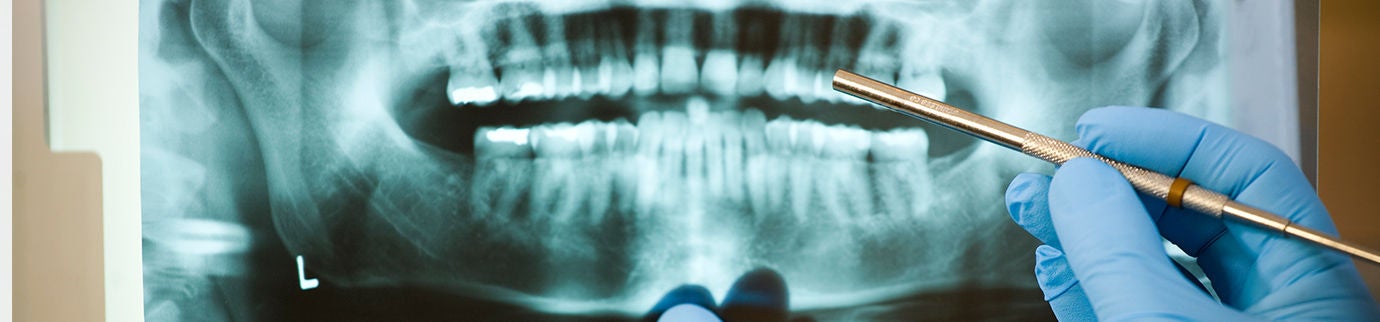 Radiografia dentária sendo analisada por dentista com luvas, destacando possível causa de sensibilidade na raiz do dente