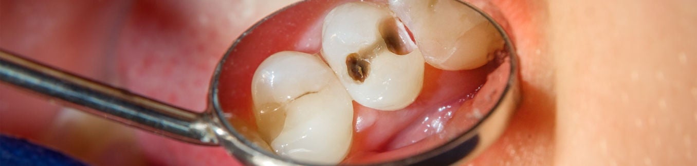 Exame dental mostrando cárie em dente refletida no espelho odontológico