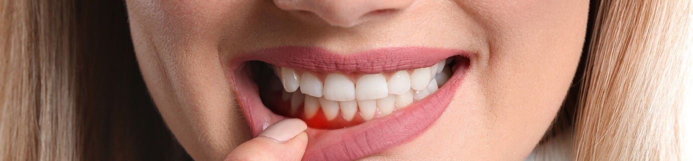 Mulher apontando para a região da boca, ilustrando desconforto e vermelhidão relacionados à gengiva sensível