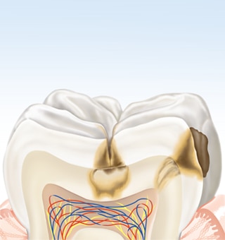 O esmalte abaixo da superfície do dente é cada vez mais dissolvido